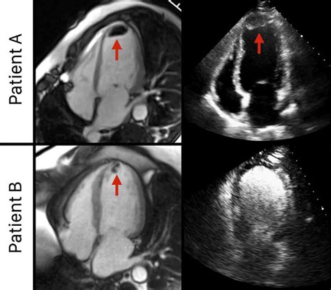 lv left ventricular mural thrombus without mi|chest guidelines Lv thrombus.